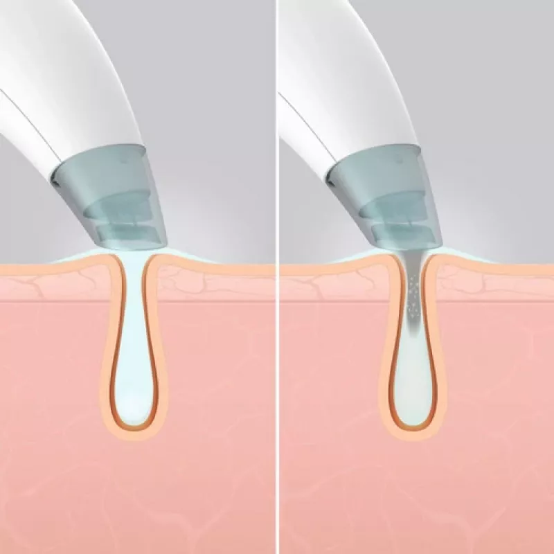 Urządzenie do pielęgnacji skóry HoMedics FAC-HY100 Oczyszczacz hydradermabrazyjny Przezroczysty, Biały